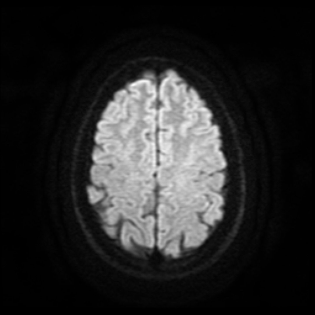 Corte de una resonancia magnética cerebral